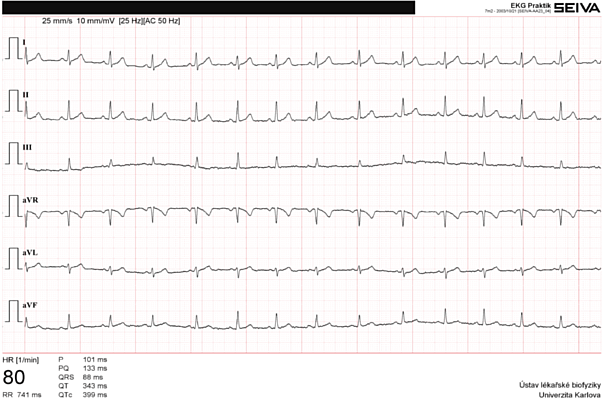Normální EKG - končetinové svody
