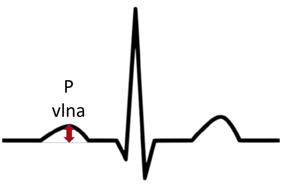 Amplituda P vlny